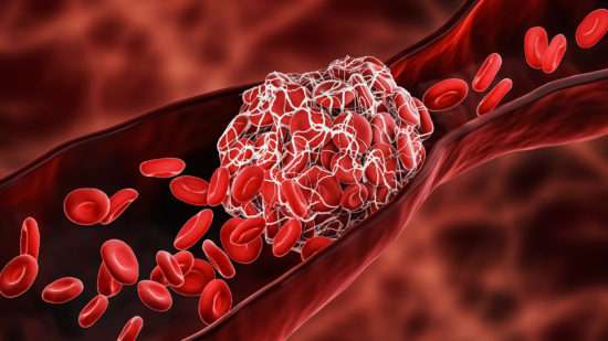 AstraZenda Adverse Events Death Suspension copy Blood Clot or thrombus blocking the red blood cells stream within an artery or a vein 3D rendering illustration. Thrombosis, cardiovascular system, medicine, biology, health, anatomy, pathology concepts.